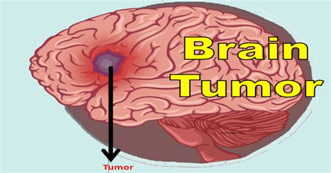 Brain Tumor Headache Symptoms Treatments Causes