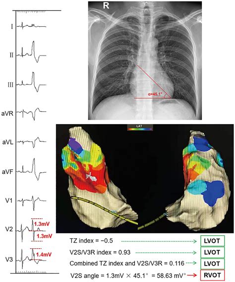 Frontiers A Novel And Effective Ecg Method To Differentiate Right