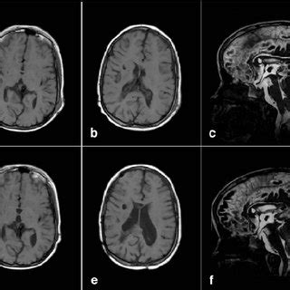 Case Report 2 A B Preoperative CT Scan Depicting Slit Like