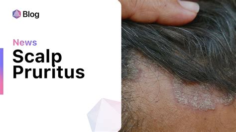 Demystifying Scalp Itching: An In-Depth Guide to Pruritus of the Scalp