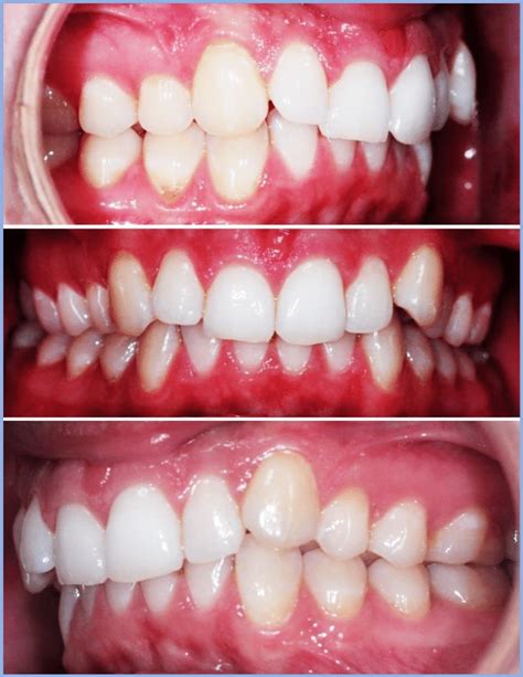 E The Labial Views Of The Teeth Prior To The Onset Of Treatment The Download Scientific