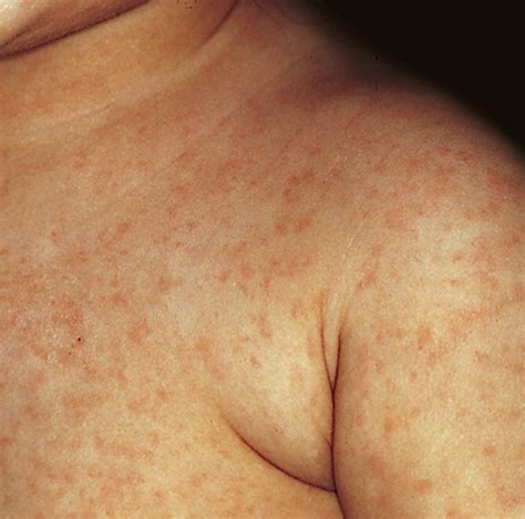 German Measles Pictures Symptoms Causes Treatment 2018 Updated