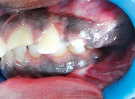 Clinical Photograph Showing The Melanotic Gingival Enlargement In The