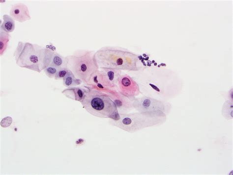 fig  atypical squamous cells  undetermined significance asc