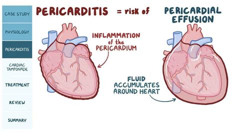 Pericardial disease: Pathology review: Video, Causes, & Meaning | Osmosis