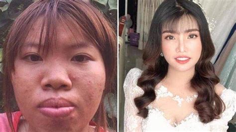 Wanita Yang Dulu Viral Berubah Cantik Seusai Operasi Plastik Sudah