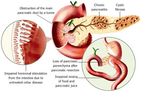 Pancreatic elastase & pancreatic elastase 1 test