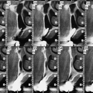 Initial Situation With Severely Malpositioned Implant And An Inadequate