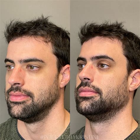 Patient Jawline Contouring Before After Photos Dr