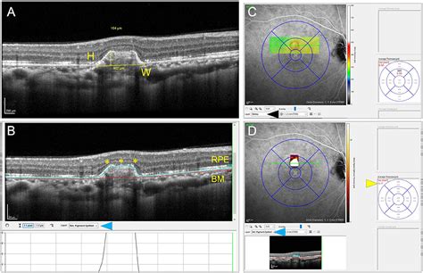 Choroidal Neovascular Membrane Diagram