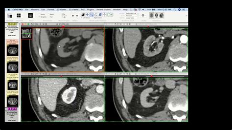 Renal Mass With Ice Cream Cone Sign Think Of Aml Nelly Tan Youtube