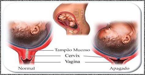 Tamp O Mucoso O Que E Para Que Serve Prepara O Para O Parto