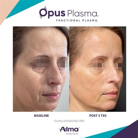 Opus Plasma Skin Tightening Gallery The Beauty Spot In Boulder Colorado