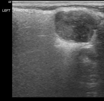 Pleomorphic Adenoma Parotid Gland Radiology Case Radiopaedia Org