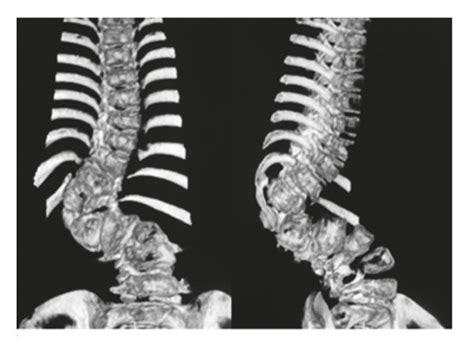 The Patient Was A 9 Years Old Boy With Lumbar Congenital Scoliosis A