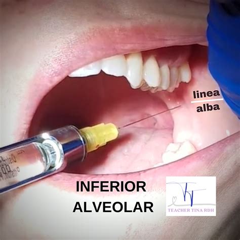 MANDIBULAR BLOCKS More Than Just The IA