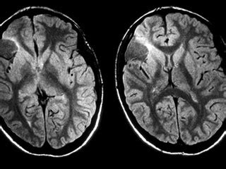 Lissencephaly – Symptoms, Causes, Treatment, Preventions, Diagnosis