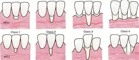 牙龈萎缩和正常牙龈图片对比 看看你的牙龈还有救吗？ 口腔医院新闻 398口腔网