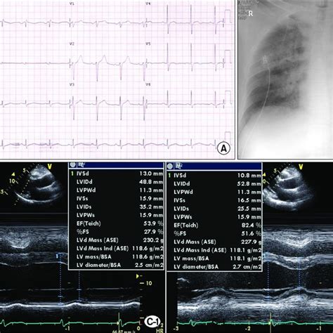 Electrocardiogram Ecg Chest X Ray And Transthoracic Echocardiography Images