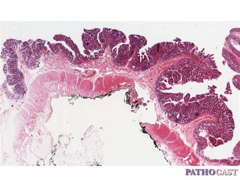 Villous Adenoma Histology