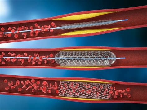 Procedimiento de angioplastia con balón de renderizado 3d con stent en