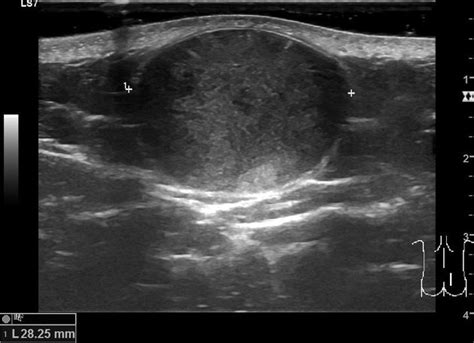 Subcutaneous Dermoid Cyst Ultrasound