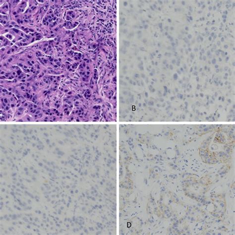 Liver Mass A Hematoxylin And Eosin Hande ×40 Image Of The Needle Core Download Scientific