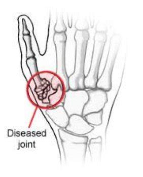 CARPOMETACARPAL ARTHRITIS — Miami Bone & Joint Institute | Premier Center For Upper And Lower ...