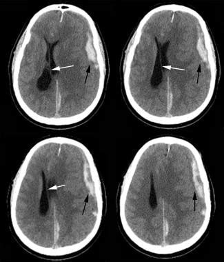 Trauma cranico chiuso: Background, fisiopatologia, Epidemiologia | Mex Alex