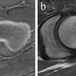 Zero Echo Time ZTE Versus Proton Density Weighted Images Swiss Axial