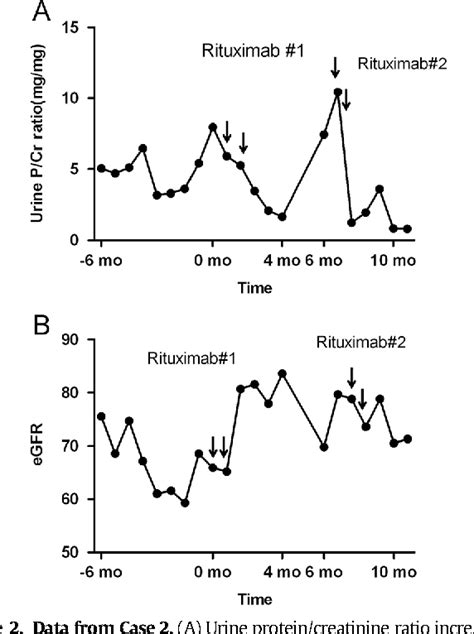 Figure 1 From Two Cases Of Idiopathic Membranous Nephropathy Treated With Rituximab Semantic