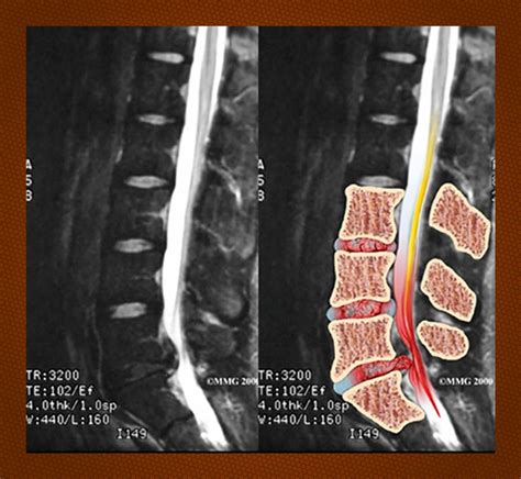 Disc Mri Mri Scan Lumbar Herniation Lumbar Disc