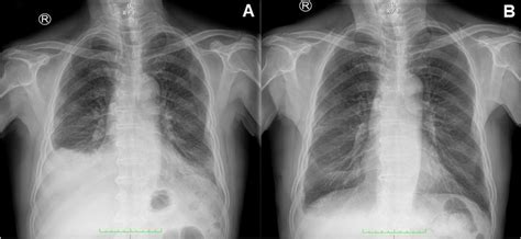 Chest radiography image of the patient | Download Scientific Diagram