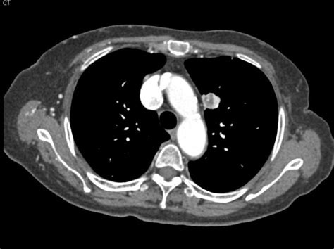 Vascular Muscle Metastases From Renal Cell Carcinoma Chest Case