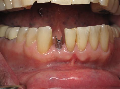 Lower Front Tooth Implants