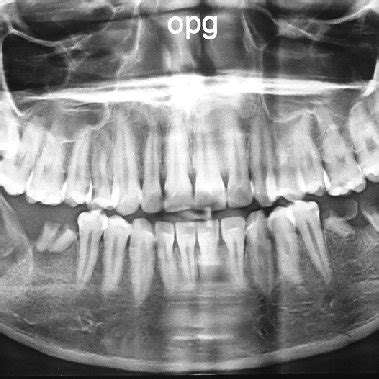 Orthopantomograph Showing A Large Unilocular Radiolucency In