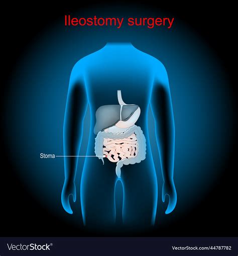 Ileostomy Stoma Surgical Opening Of Small Vector Image