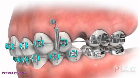 Orthodontic Mini Implant Tad Or Tsa Youtube