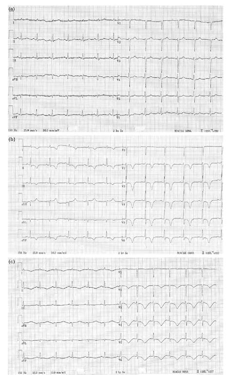 Figure 1 From Takotsubo Cardiomyopathy And Severe Hypothyroidism Semantic Scholar