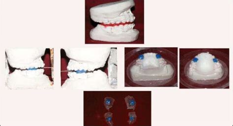 Composite Bite Blocks—an Indigenous Simple Fixed Class Ii Corrector Priyanka Jayaram P P