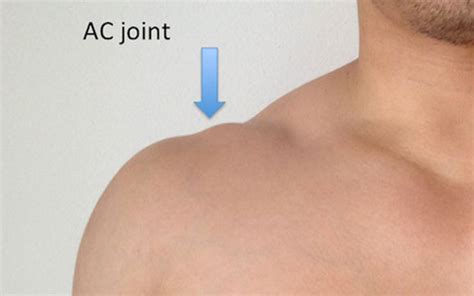 Acromioclavicular Joint Arthritis