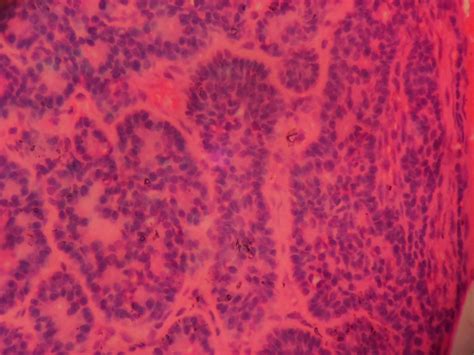 Basal Cell Adenoma Histopathologyguru