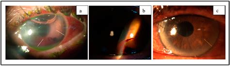 Jcm Free Full Text Descemet’s Membrane Detachment During Phacocanaloplasty Case Series And