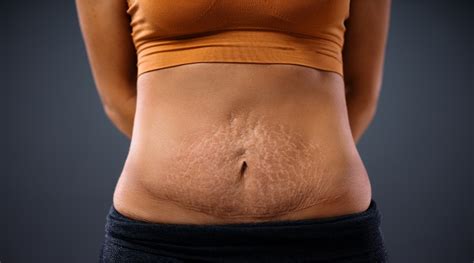 How To Tighten Skin On Stomach Fast Non Surgical Methods