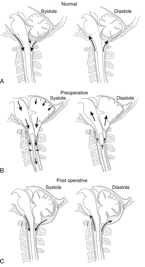 Management Of Chiari Malformations And Syringomyelia Clinical Tree