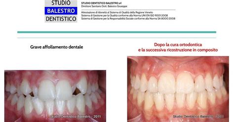 Studio Dentistico Balestro Incisivi Laterali Superiori Conoidi