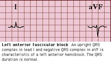 Left anterior fascicular block | Ecg interpretation, Happy students ...