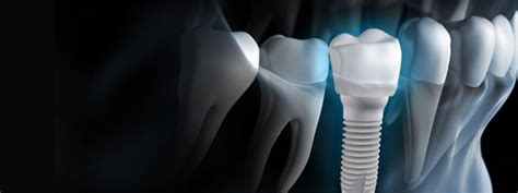 Ceramic Vs Titanium Implants The Crown S Perspective Dr Dan Hagi