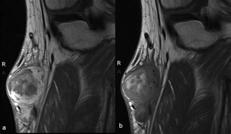 Imaging Features Of Myxoid Soft Tissue Tumours Clinical Radiology