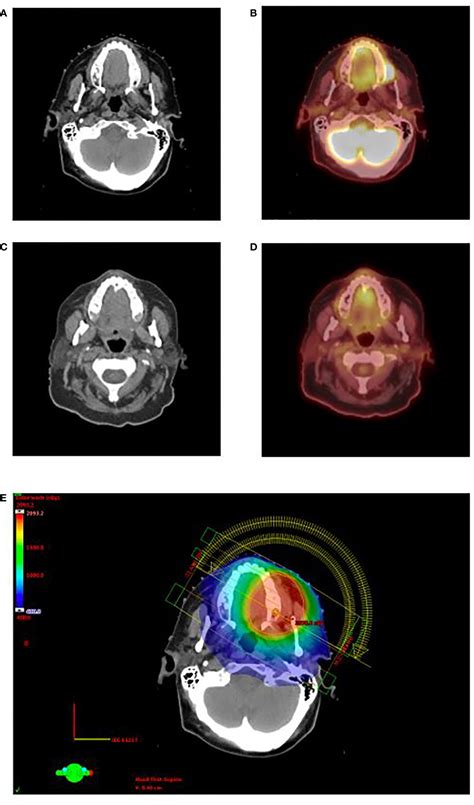 Frontiers Radiation Therapy For Chemotherapy Refractory Gingival